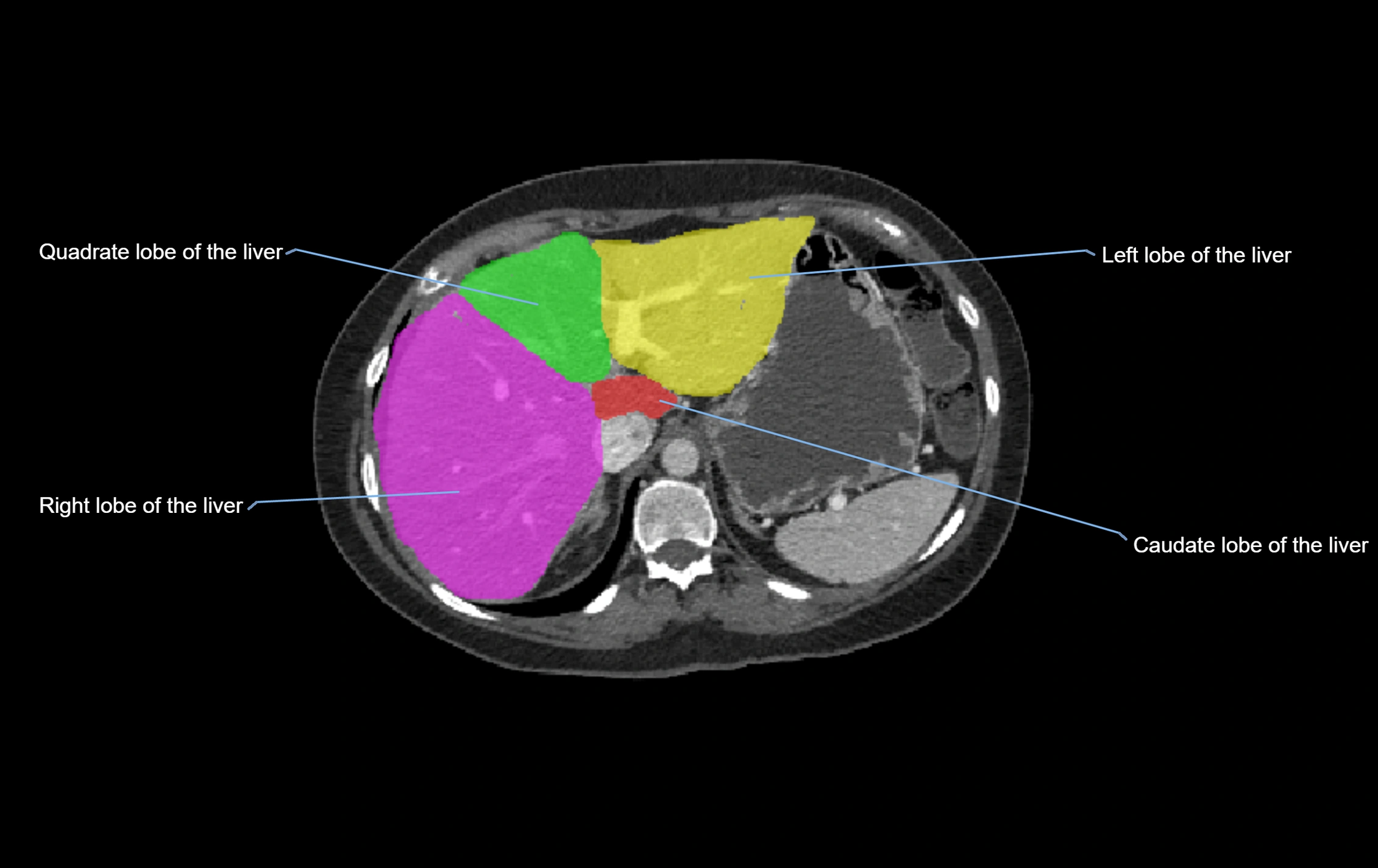 CT lliver lobes axial cross sectional anatomy labelled image -00054.webp